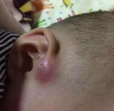 宝宝耳朵孔里有个小孔(宝宝耳朵旁有个)