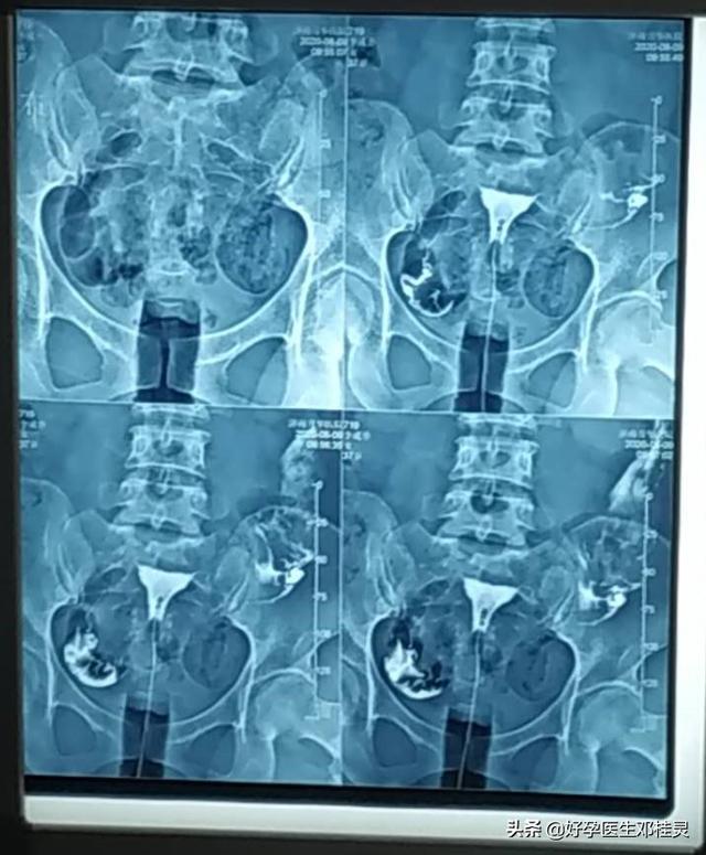 做了输卵管造影以后多久可以备孕(子宫输卵管造影后不到一个月怀孕)